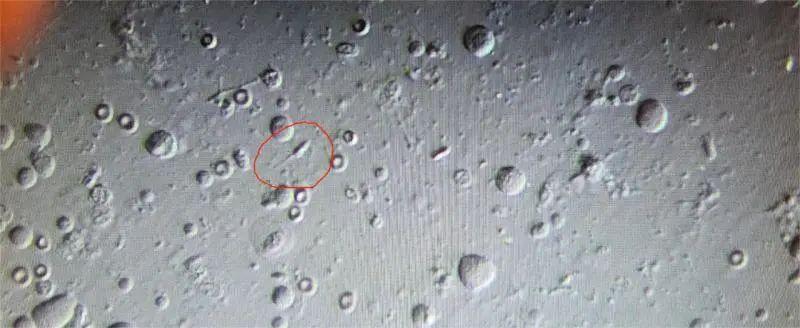 无中生有-无精症患者显微取精手术成功获取足量精子