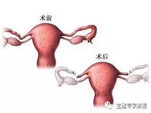 代生费-结扎了还能做试管婴儿吗？
