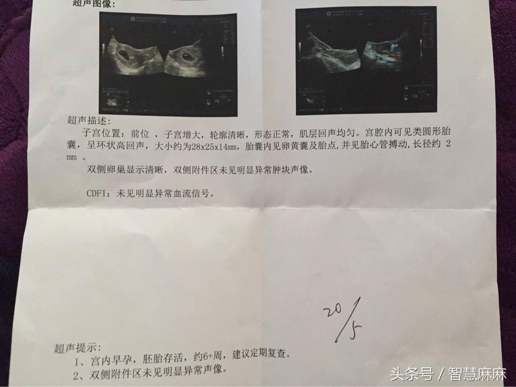 助孕男孩-孕7周,未见胎心胎芽,这是不是胎停育的先兆?