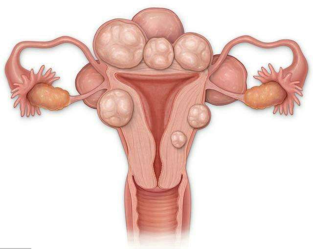 子宫浆膜肌瘤可做试管婴儿吗？