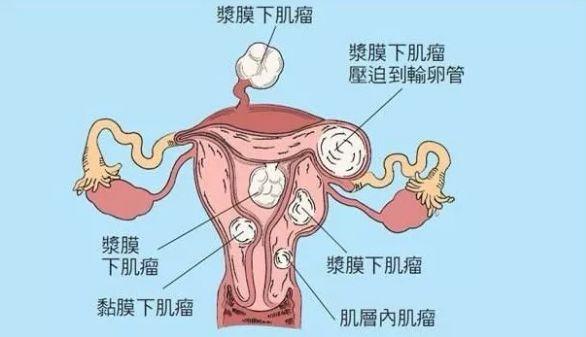 子宫浆膜肌瘤可做试管婴儿吗？
