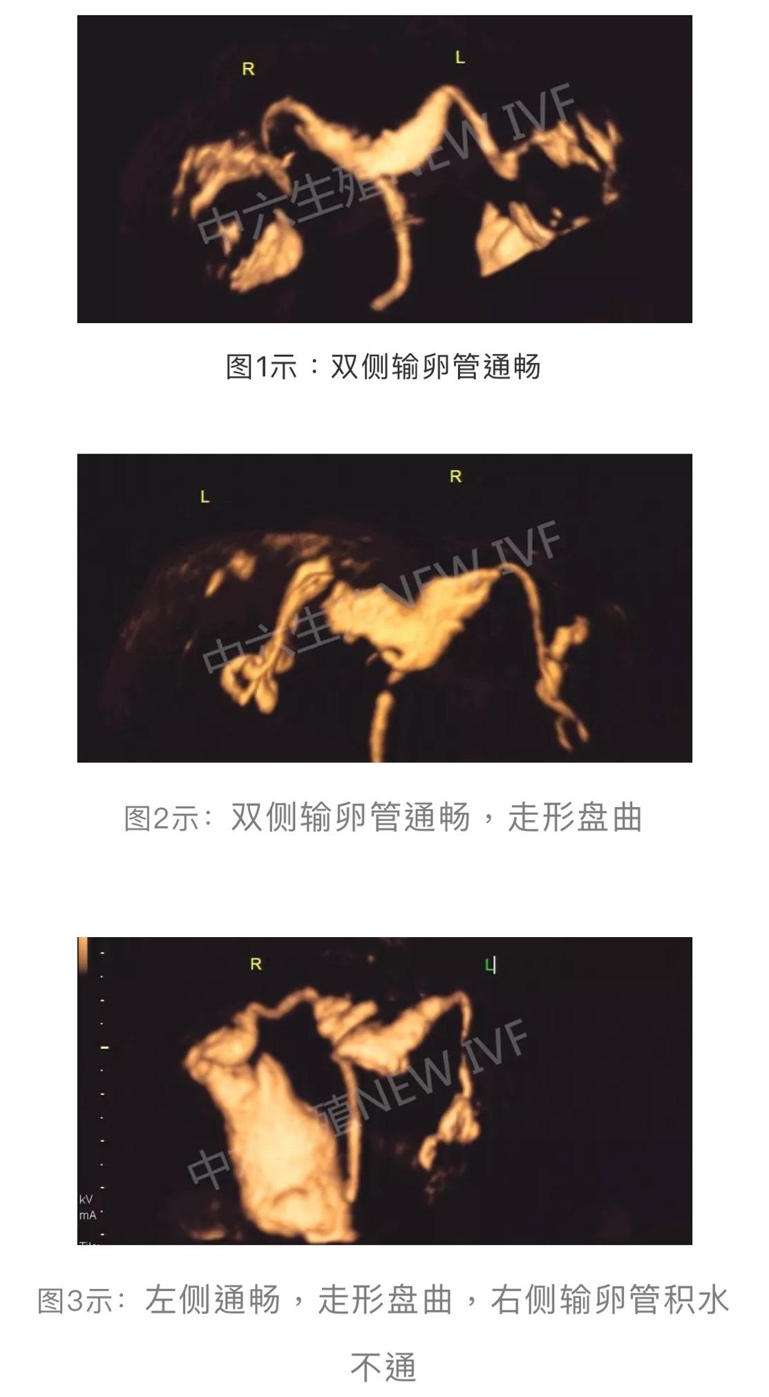 最可靠代怀~试管婴儿前需要做输卵管造影吗？需要麻醉吗？会不会很痛？