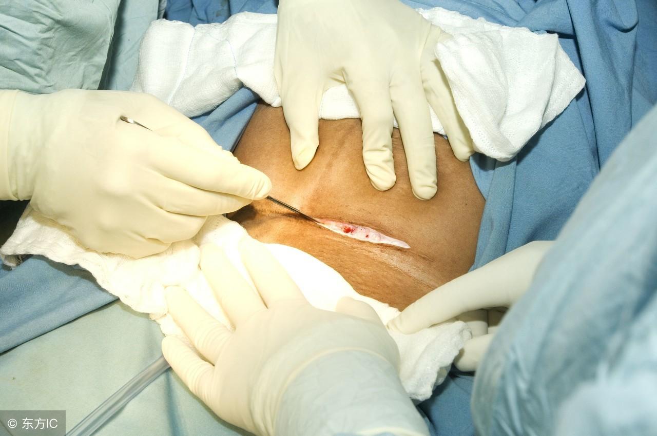 供卵代生-瘢痕妊娠手术后再次怀孕的准备