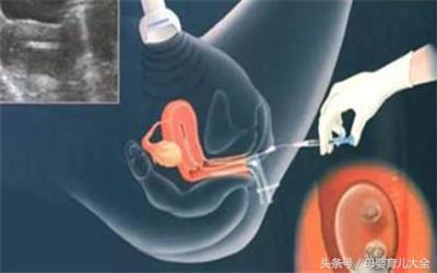 试管婴儿服务-揭秘“试管婴儿”诞生全过程!