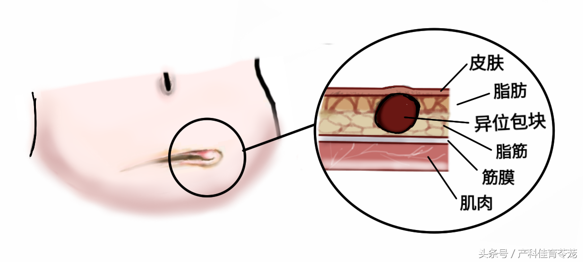 剖宫产术后当心腹壁切口子宫内膜异位症-代孕费用及明细