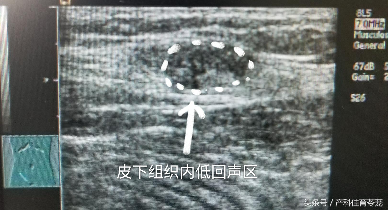 剖宫产术后当心腹壁切口子宫内膜异位症-代孕费用及明细