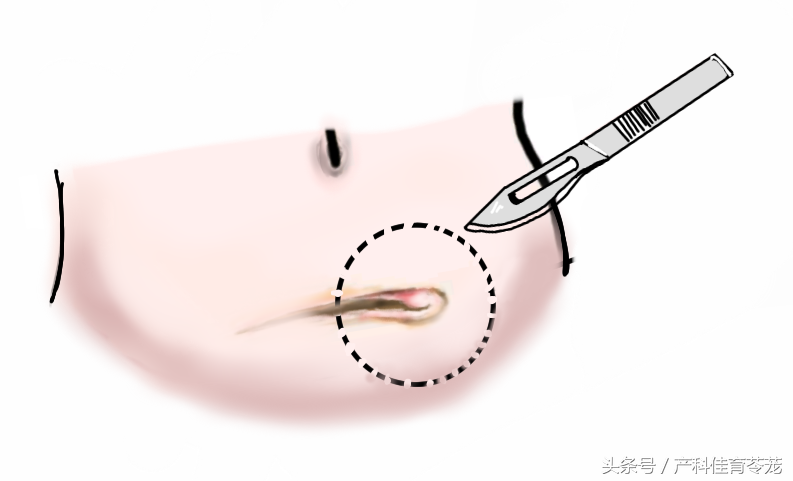 剖宫产术后当心腹壁切口子宫内膜异位症-代孕费用及明细