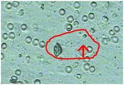 显微取精术—无精症患者最后的希望,代孕妈妈靠谱吗