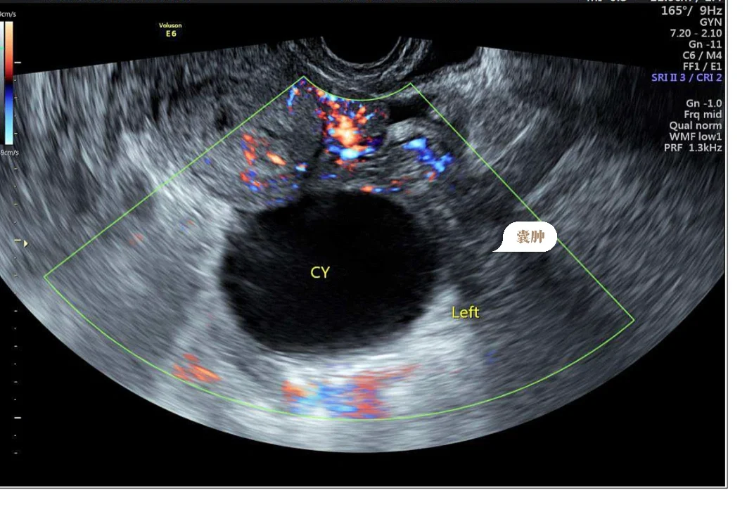 孕期分享—卵巢囊肿蒂扭转 腹腔镜手术