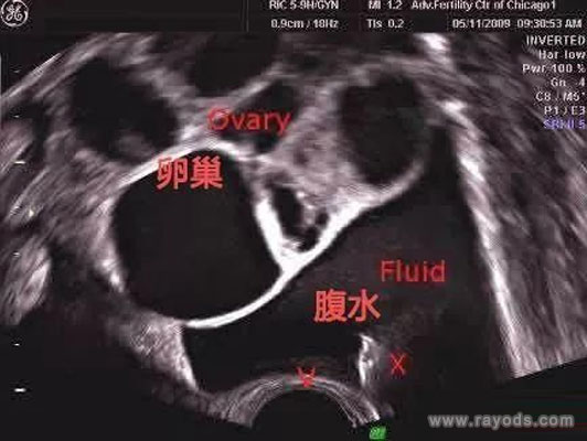 取卵后腹水如何消除,记住这6点,预防取卵后腹水,做试管医院