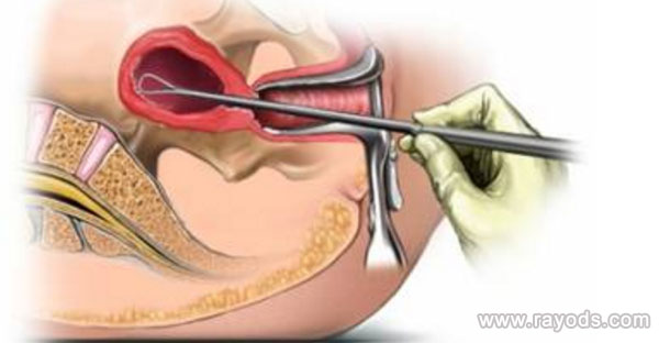 子宫内膜不典型增生可以做泰国试管婴儿吗,成功率高吗?,借卵代怀价格